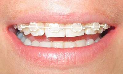 Nasazený estetický fixní aparát v horní čelisti