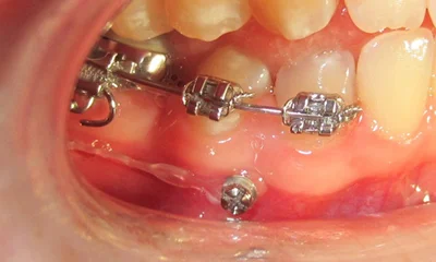 Ukázka použití ortodontického miniimplantátu