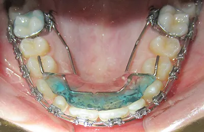 Ukázka nákusného třmenu