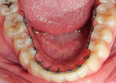 Nasazený fixní lingvální aparát v dolní čelisti