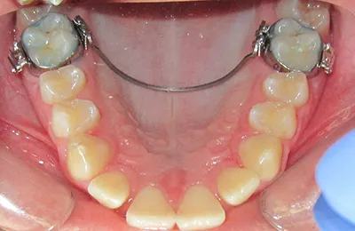 Ukázka použití patrového třmenu