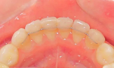 Ukázka fixního ortodontického retaineru