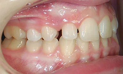 Léčba retinovaného špičáku - před léčbou