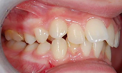 Léčba stěsnání - před léčbou