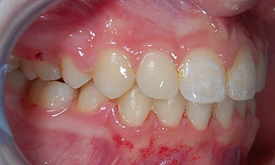 Léčba stěsnání - po léčbě