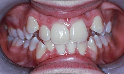 Léčba závažného stěsnání - před léčbou