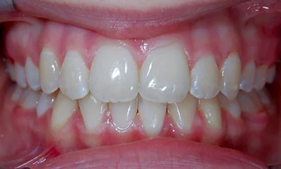 Léčba závažného stěsnání - po léčbě